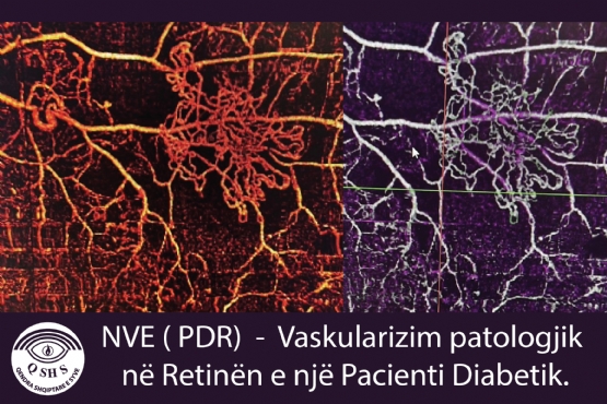 NVE (PDR) Vaskularizim patologjik ne Retinen e nje Pacienti Diabetik, ne Qendra Shqiptare E Syve, me mjek Prof Asc Ali Tonuzi