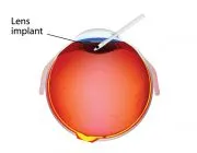 Implanti i lentes