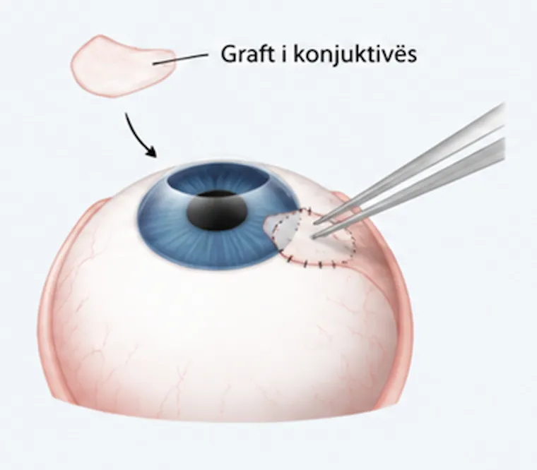 Vendosja e graftit të konjuktivës