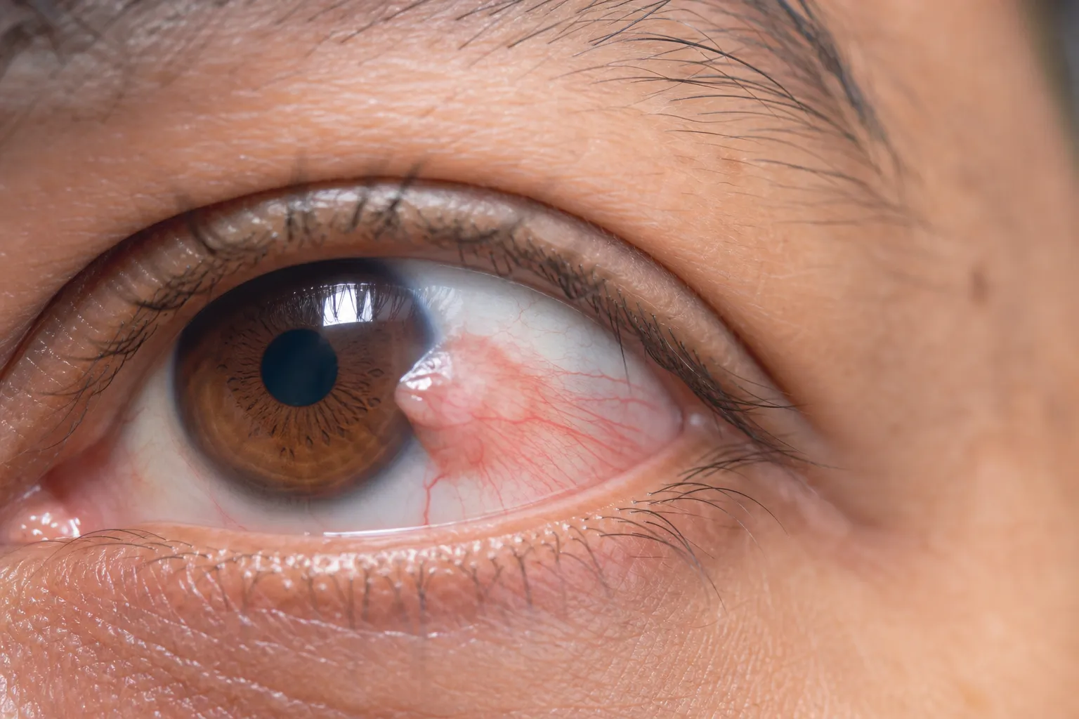 Pterigium (Syri i Surferit)